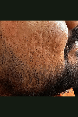 Skin before treatment at Trikaaya