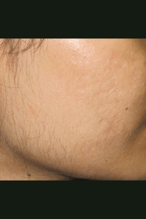 Skin after treatment at Trikaaya