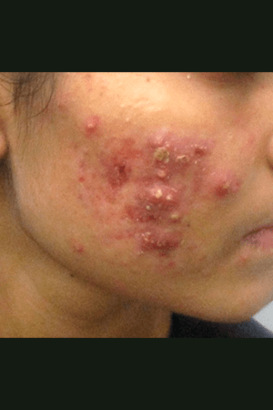 Skin after treatment at Trikaaya