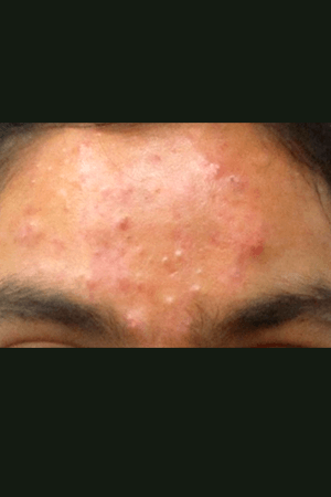 Skin after treatment at Trikaaya