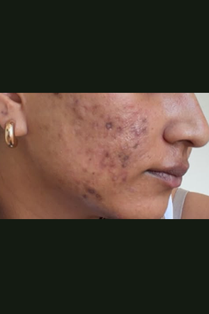 Skin after treatment at Trikaaya